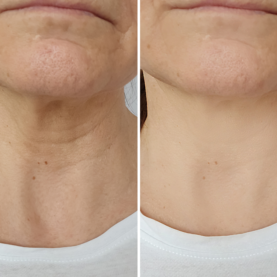 Tighter and smoother neckline