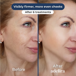 Before and after: visibly firmer, more even cheeks after 6 treatments