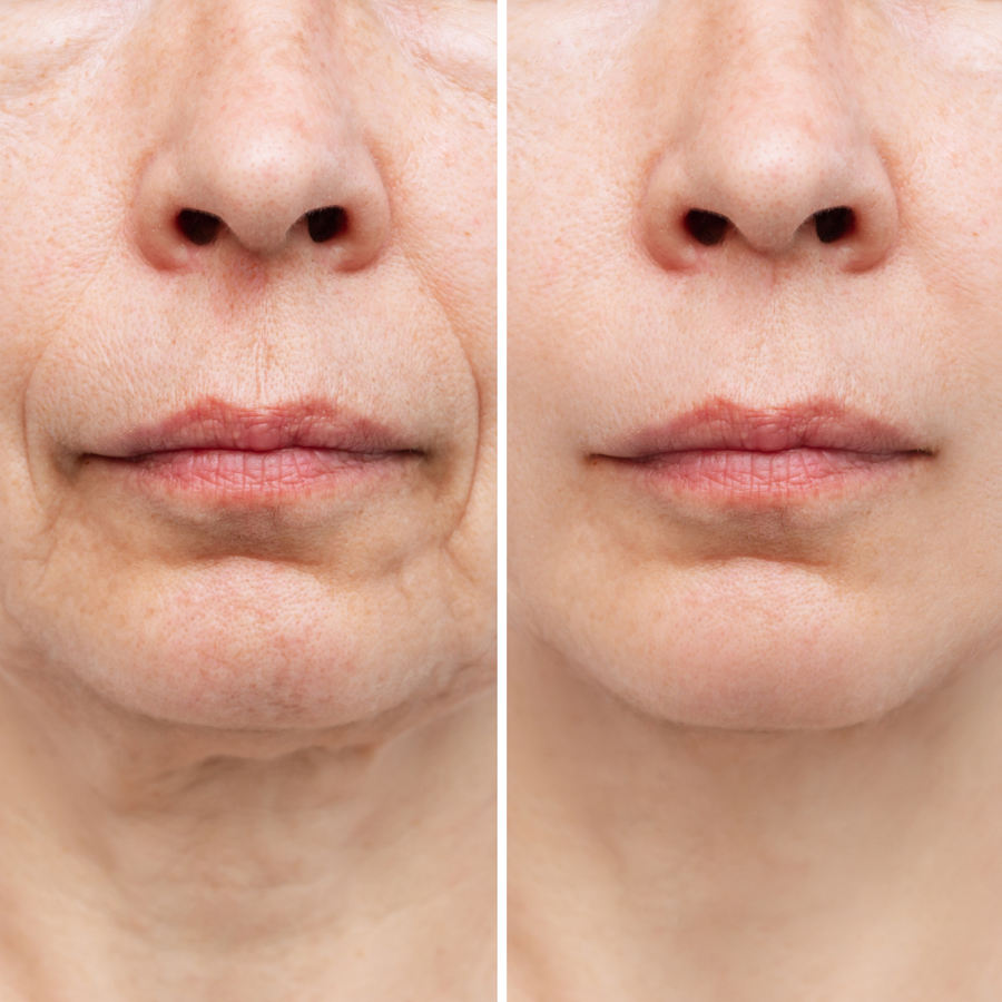 Visibly fuller lip contours