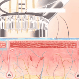 SkinFuse® Micro-Infusion System - 6-Month Offer