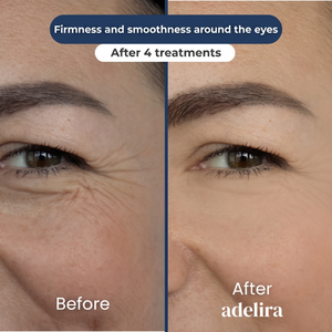 Before and after: firmness and smoothness around the eyes after 4 treatments