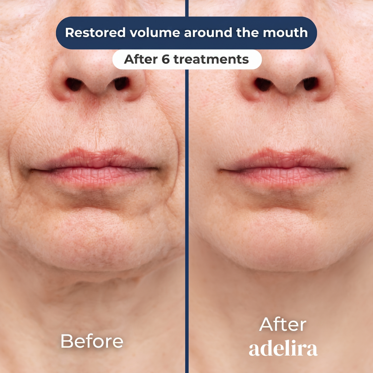 Before and after: restored volume around the mouth after 6 treatments