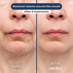 Before and after: restored volume around the mouth after 6 treatments