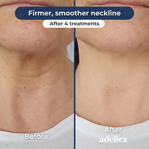 Before and after: firmer, smoother neckline after 4 treatments